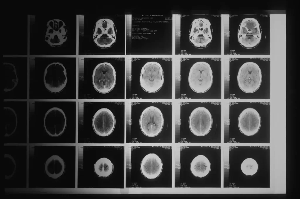 todo lo que debes saber sobre la neurocirugia