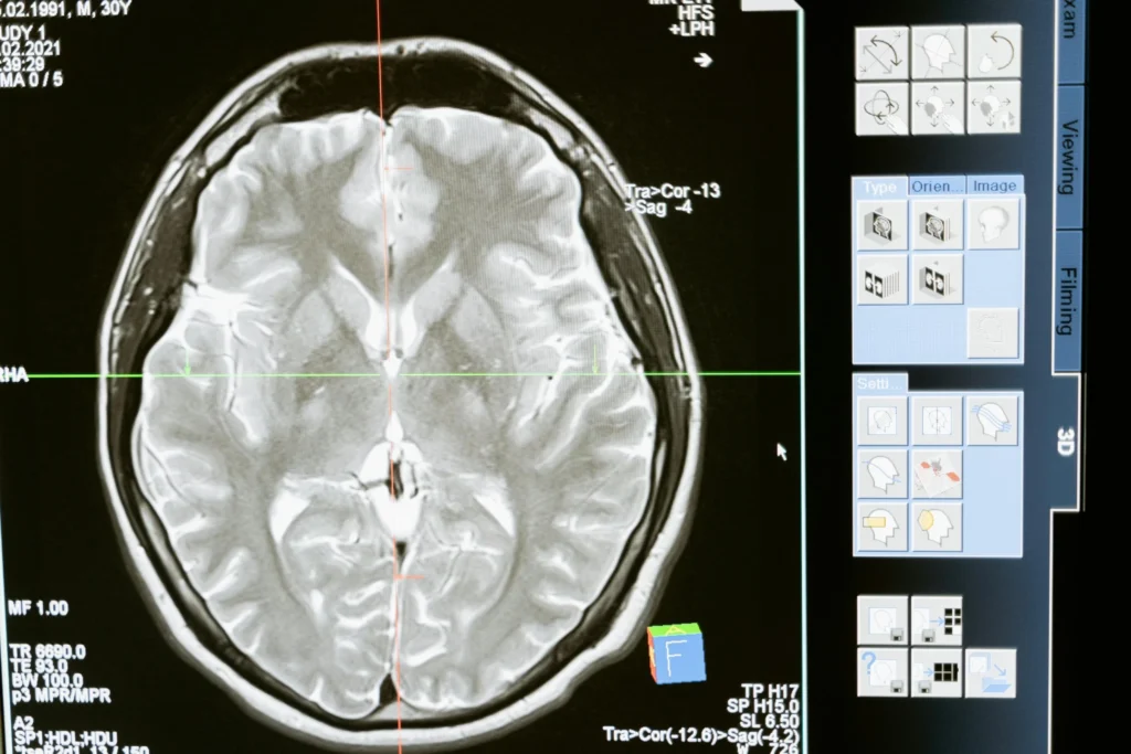tratamiento-alzheimer-últimas-noticias